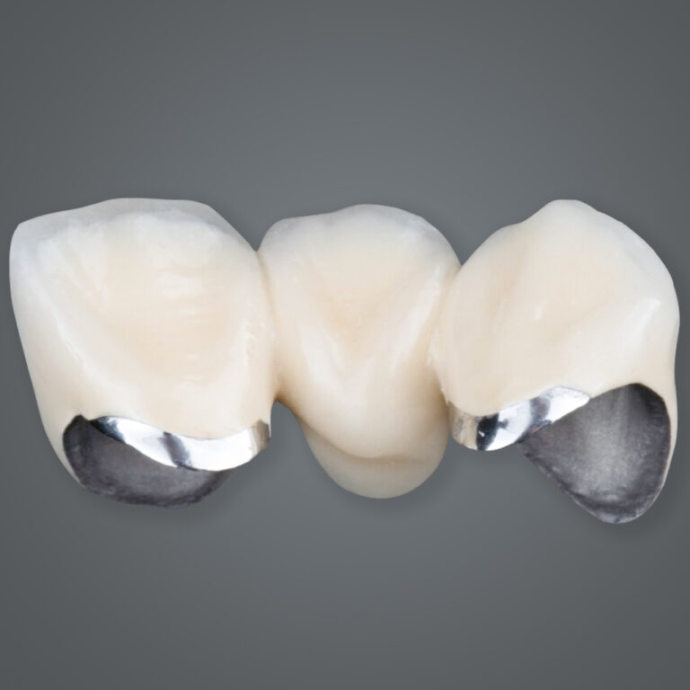 PFM – Porcelain Fused Metal Dental Crown