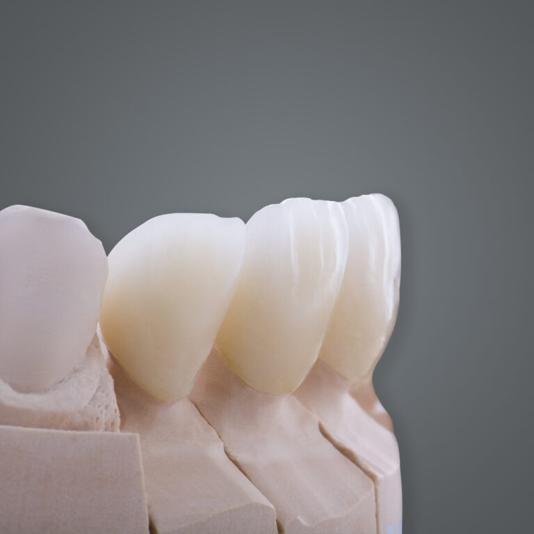 Cut-back Zirconia